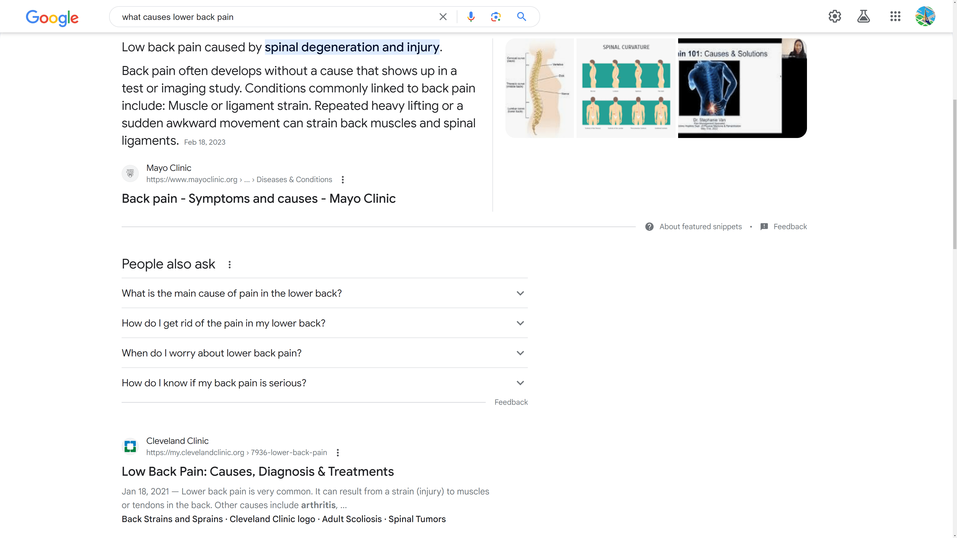 Google.com search results for “What causes lower back pain”